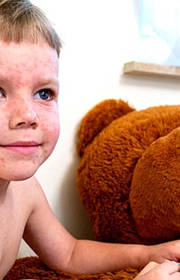 Chickenpox: managing the symptoms Chickenpox: managing the symptoms